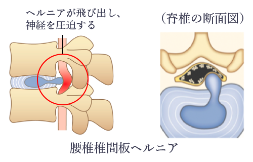 腰椎椎間板ヘルニア